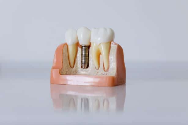 What Makes Dental Implants Feel More Natural